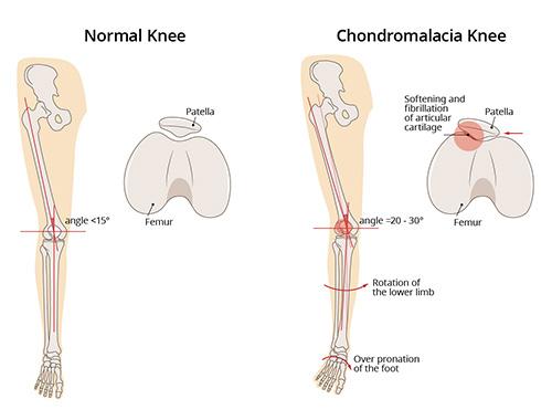 A diagram of a normal knee and a chondromalacia knee.
