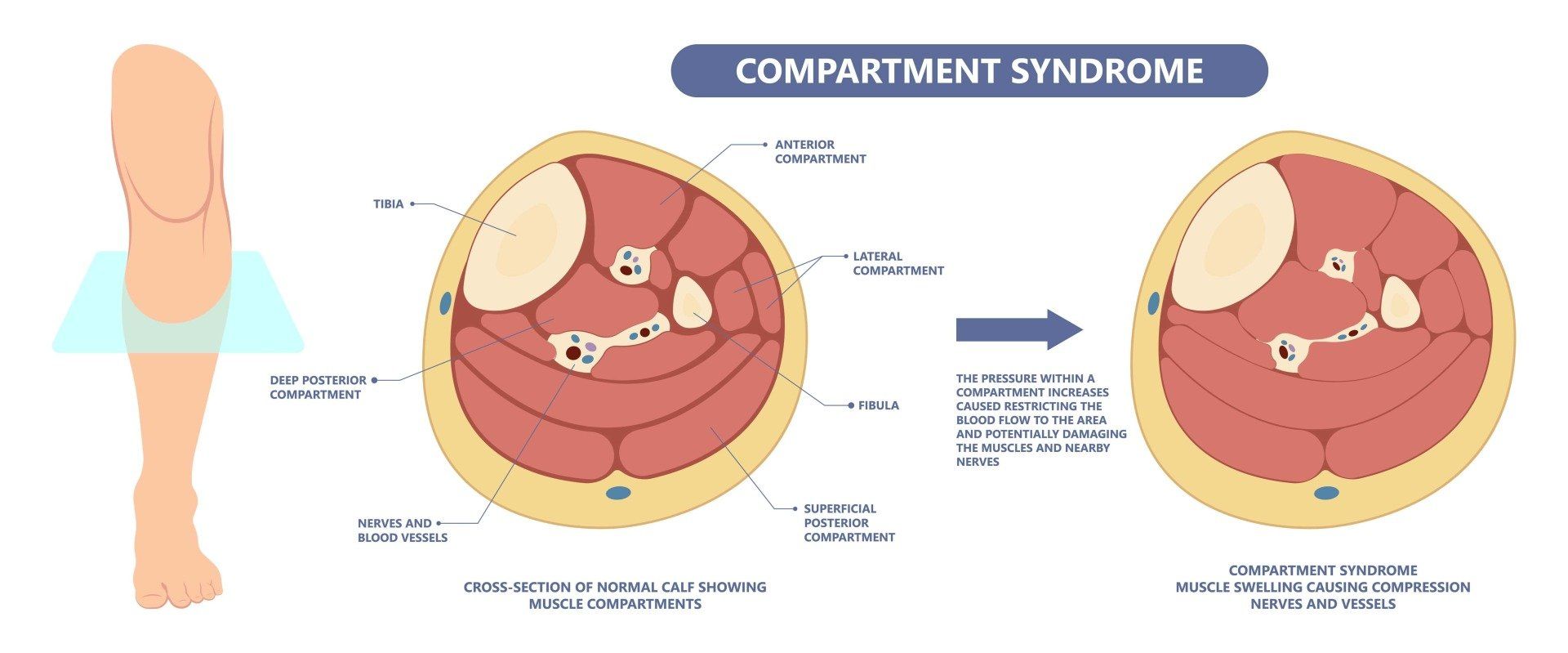 A diagram of a person 's leg with a compartment syndrome.