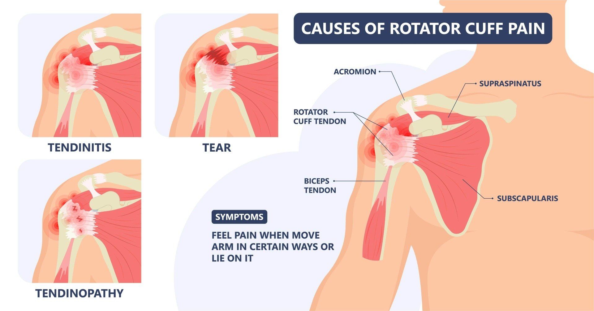 Diagram of the causes of rotator cuff pain showing the bursa and tendon under the bony arch of the shoulder