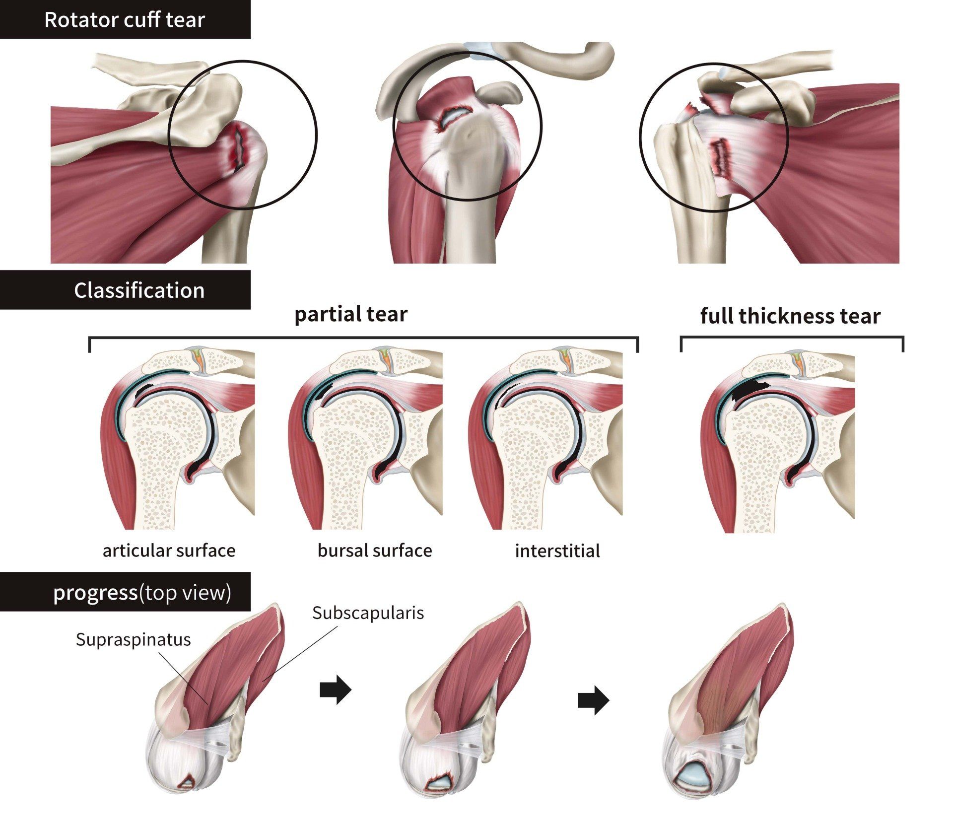 Diagram of the shoulder showing different types of rotator cuff tears: partial and full thickness