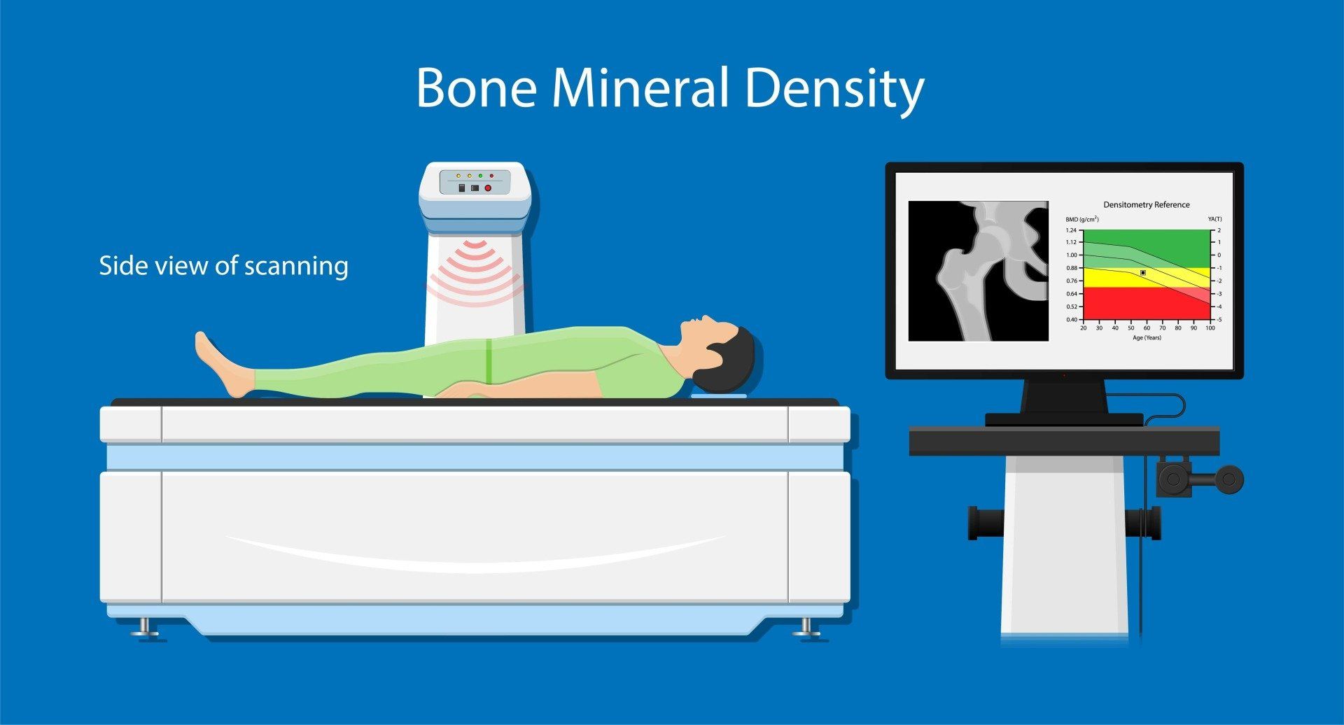 DEXA bone mineral density scan diagram