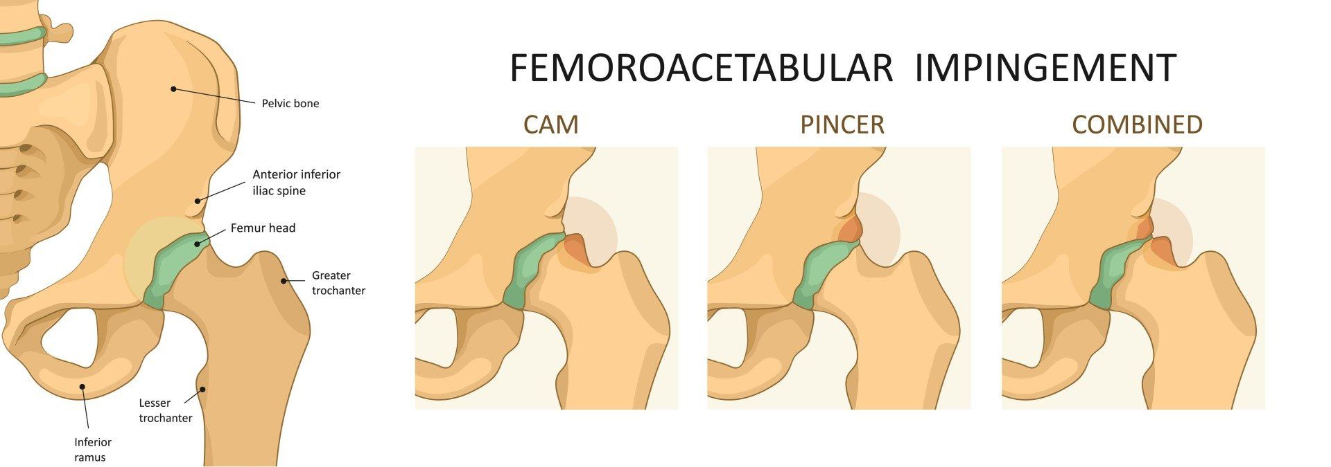 Diagram of femoroacetabular impingement types: cam, pincer and combined bony bumps around the hip