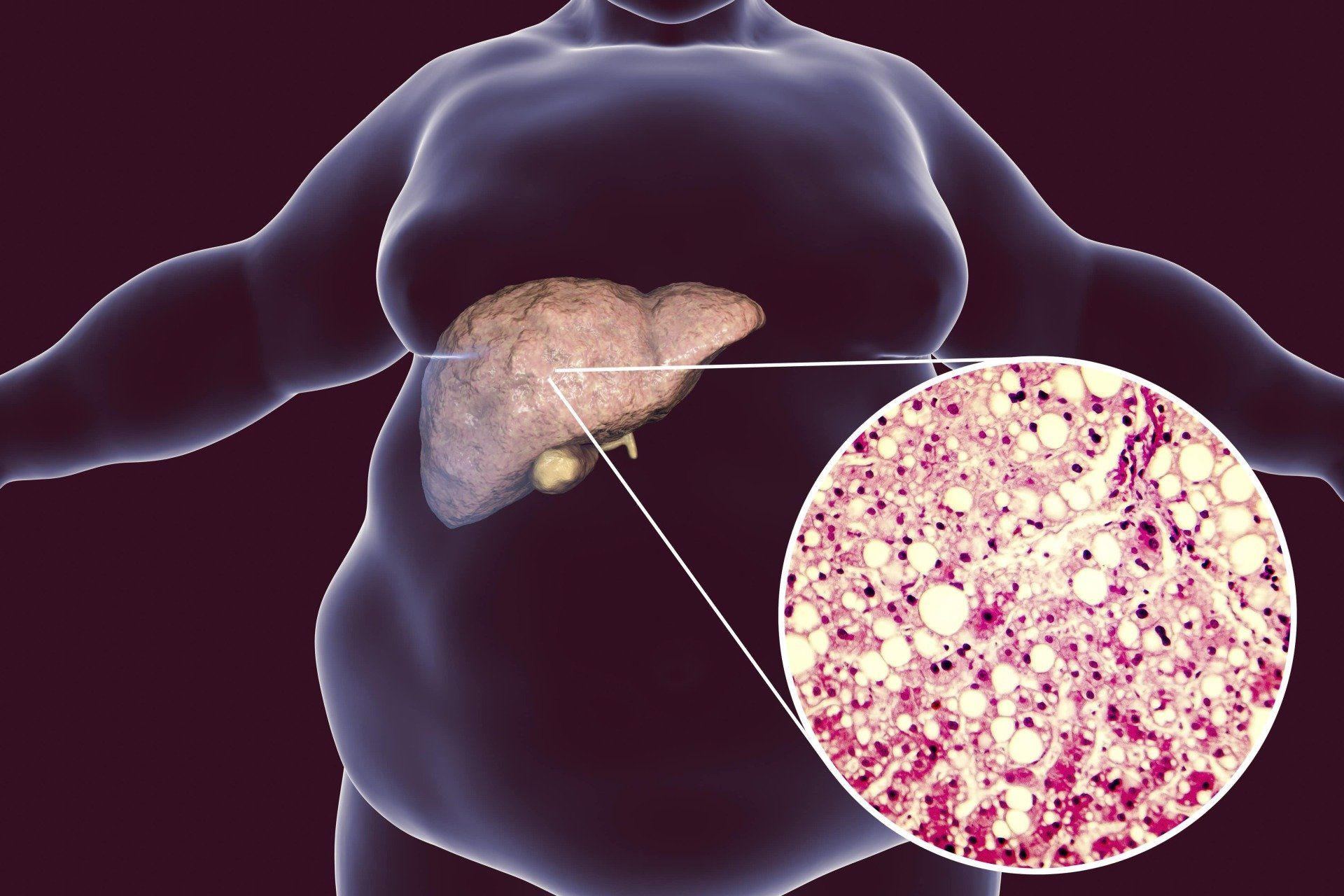 Liver with enlarged fatty tissue and magnified fat-filled cells, illustrating fatty liver disease