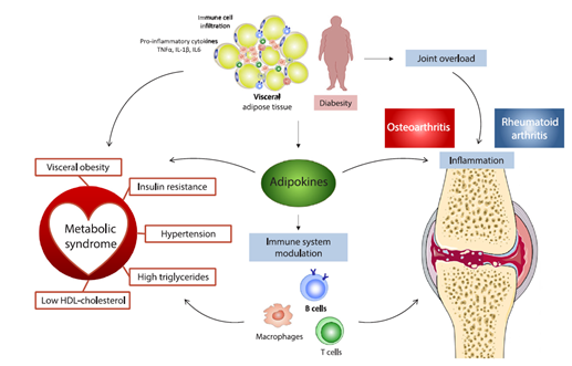 Diagram of osteoarthritis showing cartilage loss, bone changes, inflammation, and knee joint damage.