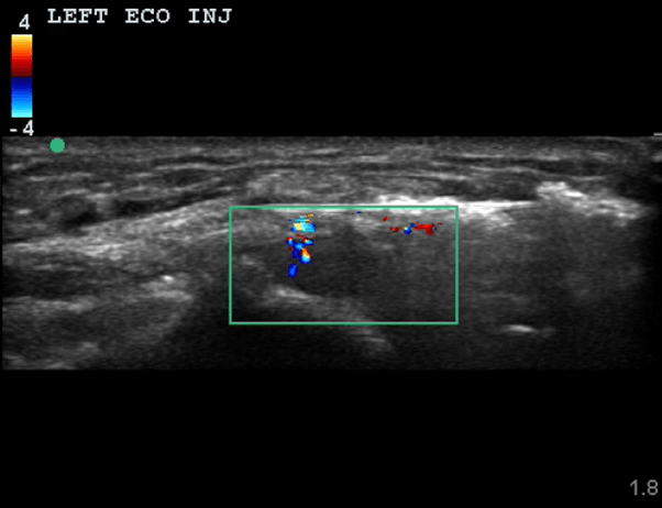 An ultrasound image of a left eco inj
