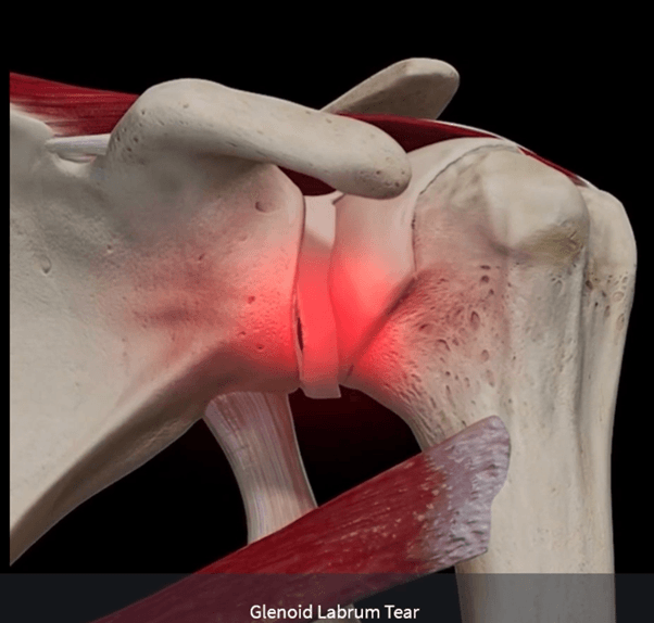 Illustration of a labral tear of the shoulder where the labrum peels away from the glenoid socket
