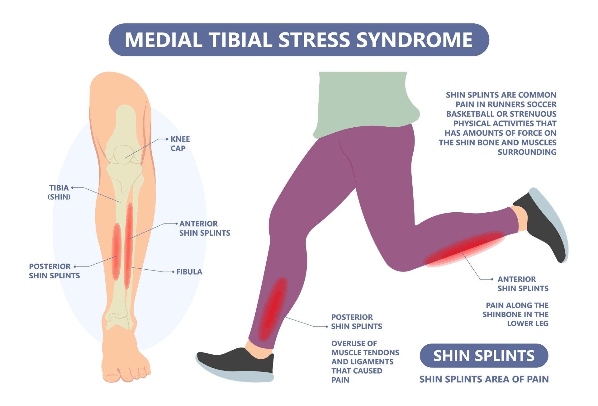 A diagram of a person with medial tibial stress syndrome and shin splints.