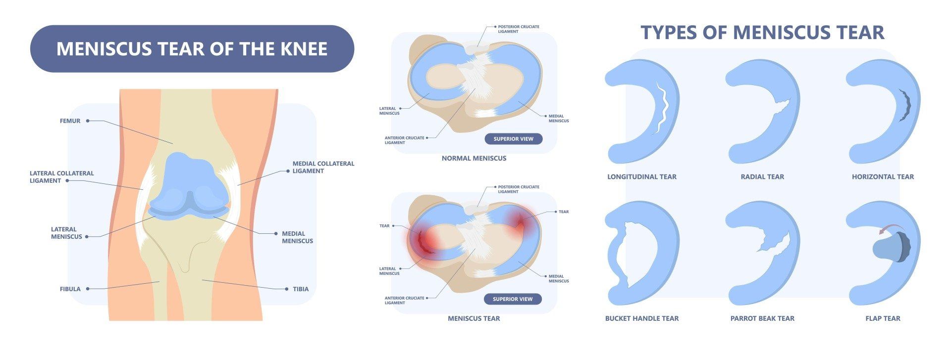 Diagram of the different patterns of meniscal tears of the knee including bucket handle, radial, parrot beak, complex and horizontal tears
