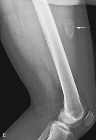 X-ray with an arrow indicating myositis ossificans, calcium forming within injured muscle