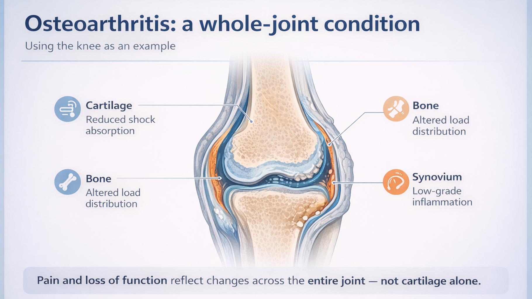 Osteoarthritis - Whole Joint Condition.
Treated at Progressive Sports Specaialists