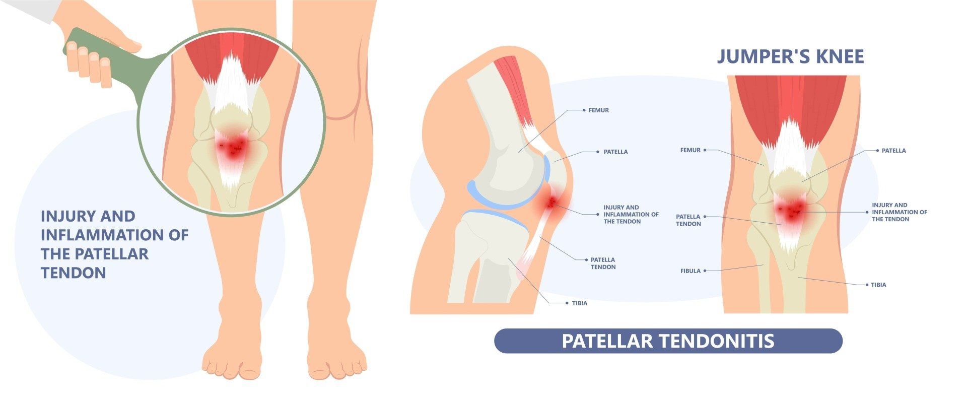Infographic of patellar tendonitis and jumper’s knee with knee anatomy and pain highlights