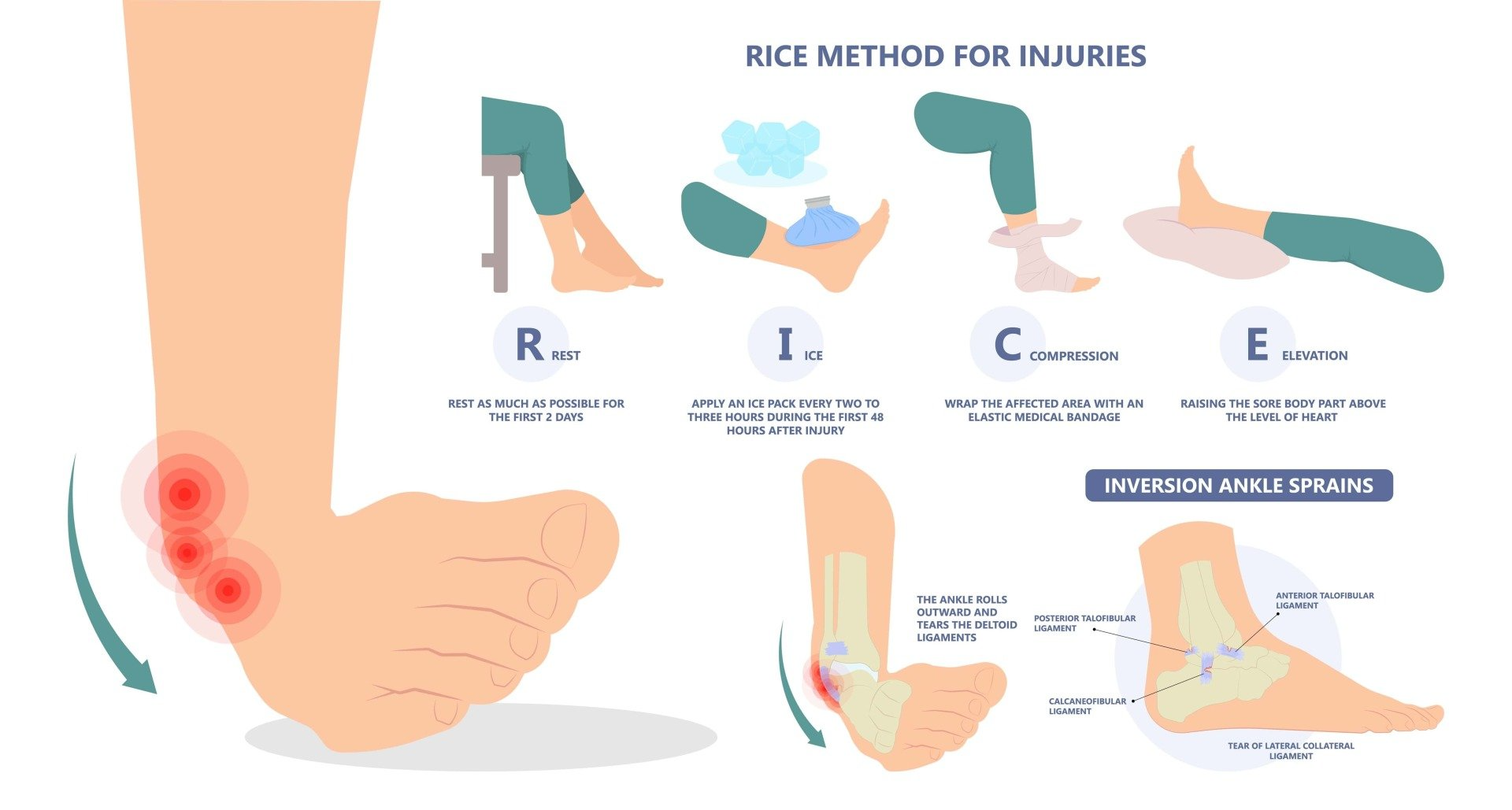 RICE injury care infographic: rest, ice, compression, elevation for ankle and foot sprains
