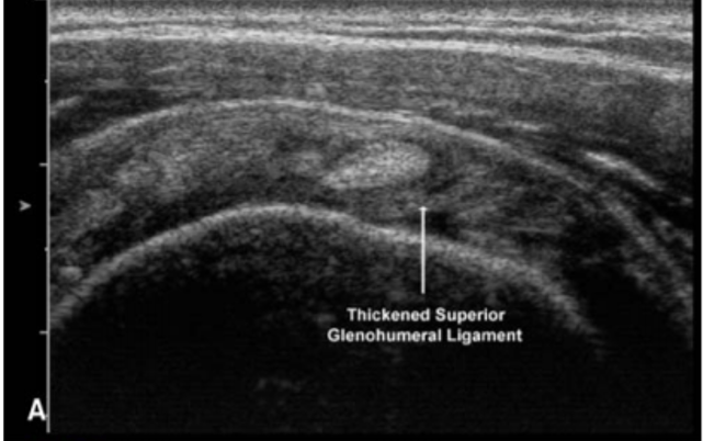 A black and white image of a thickened superior glenohumeral ligament.