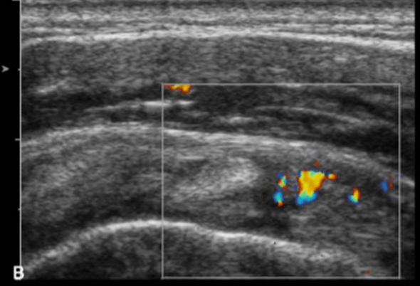 A black and white ultrasound image of a muscle with a square around it.