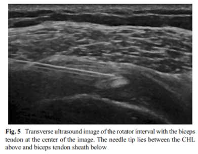 A transverse ultrasound image of the rotator interval with the biceps tendon at the center of the image