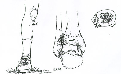 Illustration of the external rotation mechanism that causes ankle syndesmosis injuries