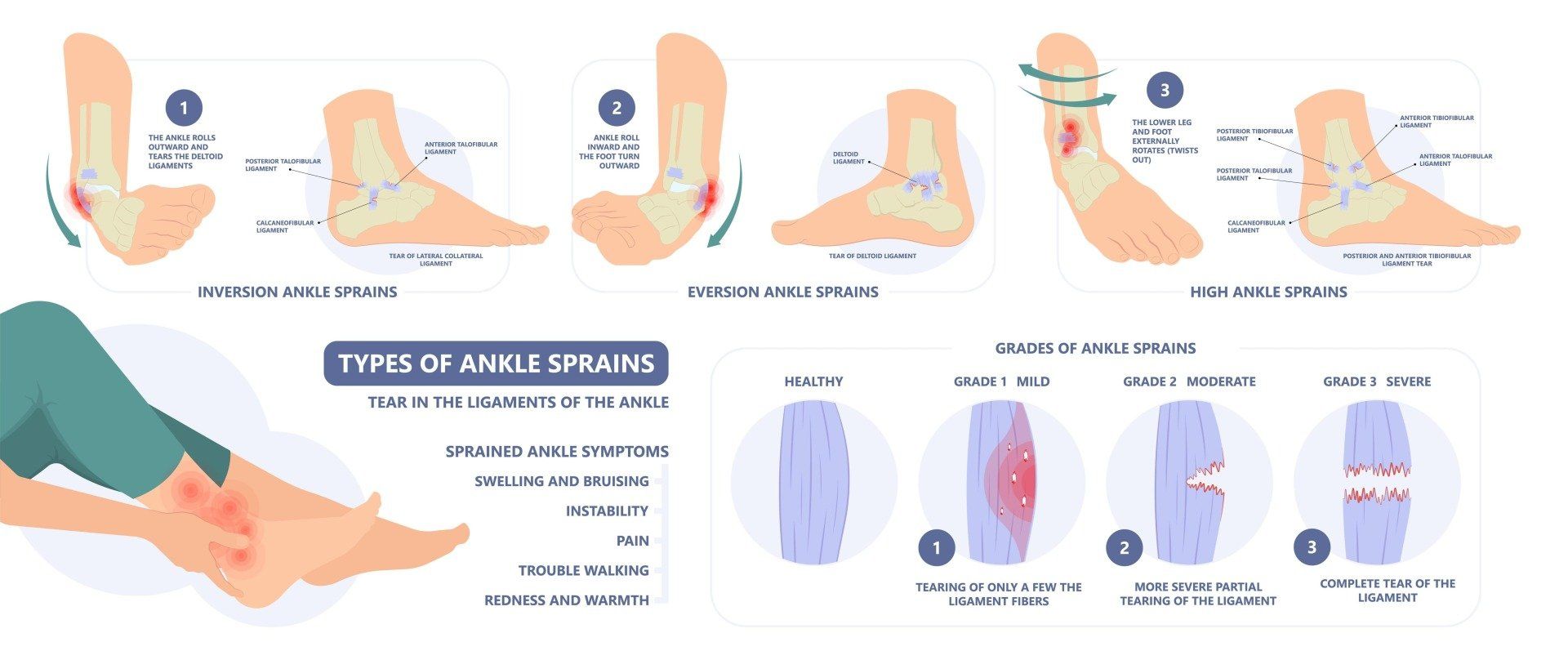 Diagram showing the different types and grades of ankle sprains and the ligaments involved