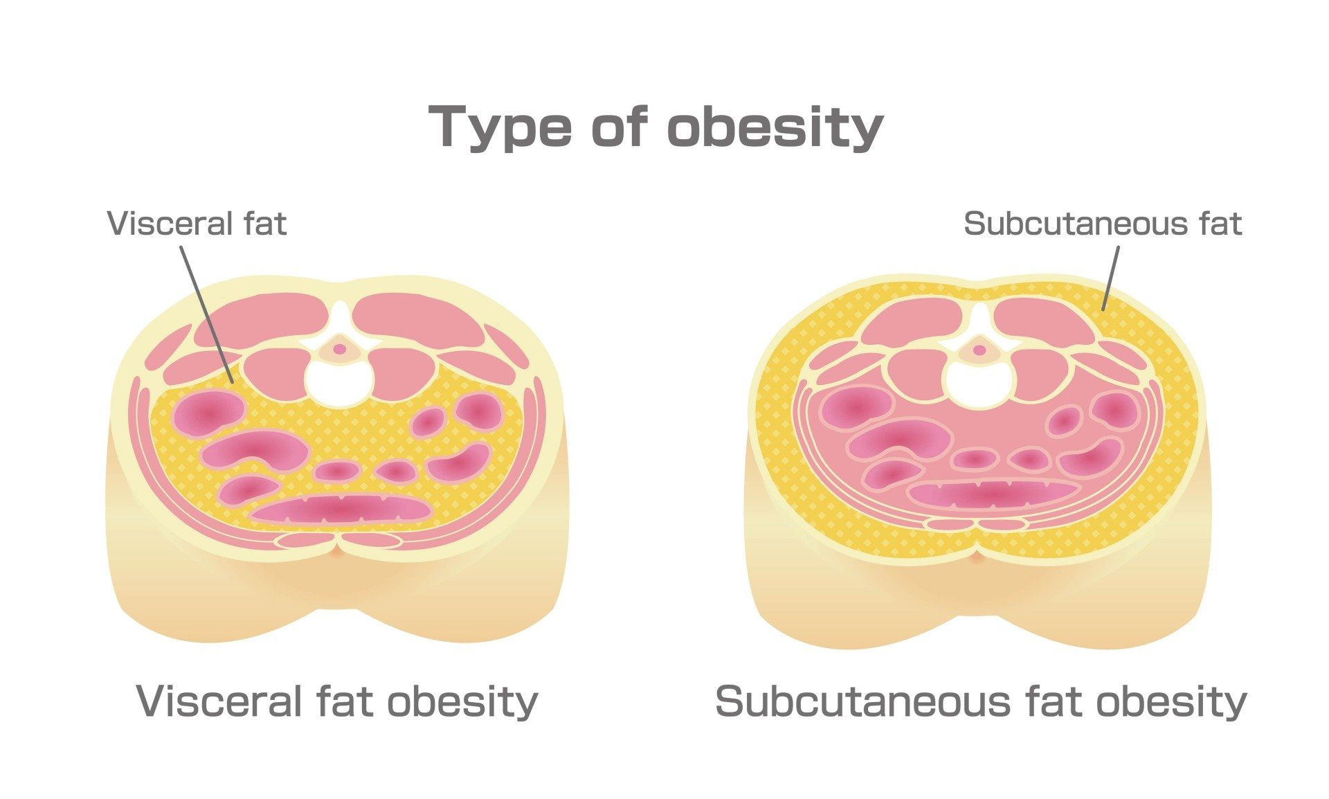 Diagram comparing visceral fat and subcutaneous fat obesity in cross-sections of the abdomen