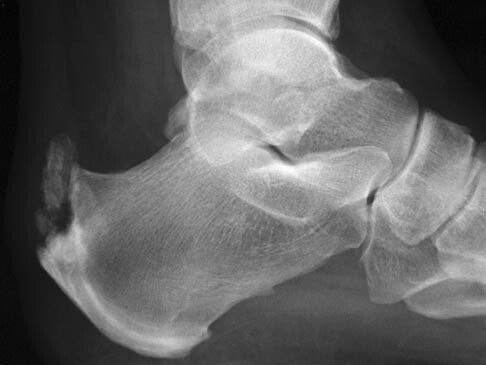 Lateral X-ray of a foot showing a prominent heel bone spur at the Achilles tendon insertion.