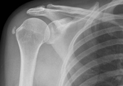 X-ray of a shoulder joint and upper arm bones with the arm slightly raised
