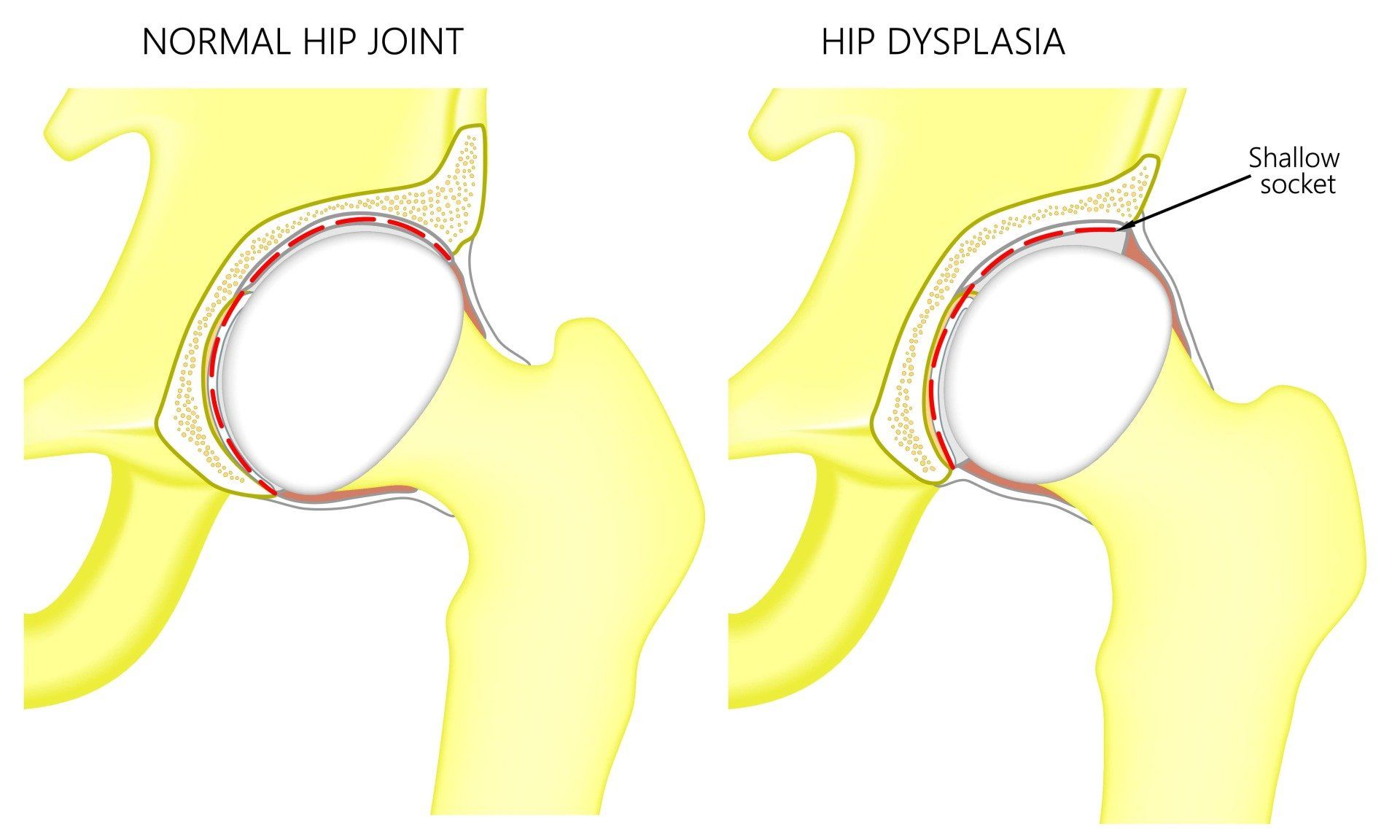 Diagram comparing a normal hip joint with developmental dysplasia of the hip where the socket is shallow