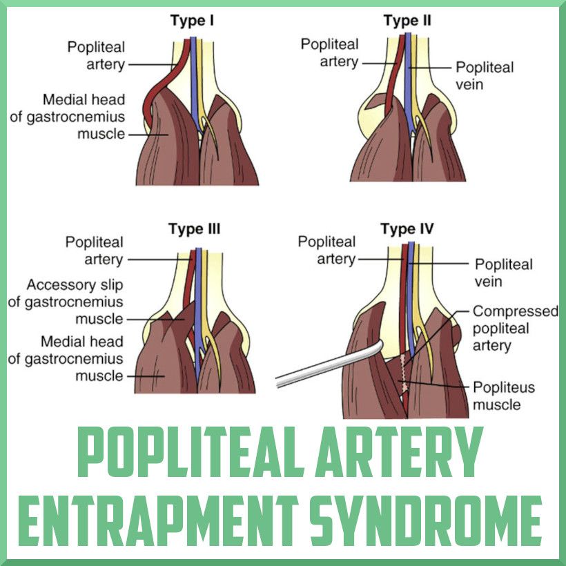 A diagram of a popliteal artery entrapment syndrome