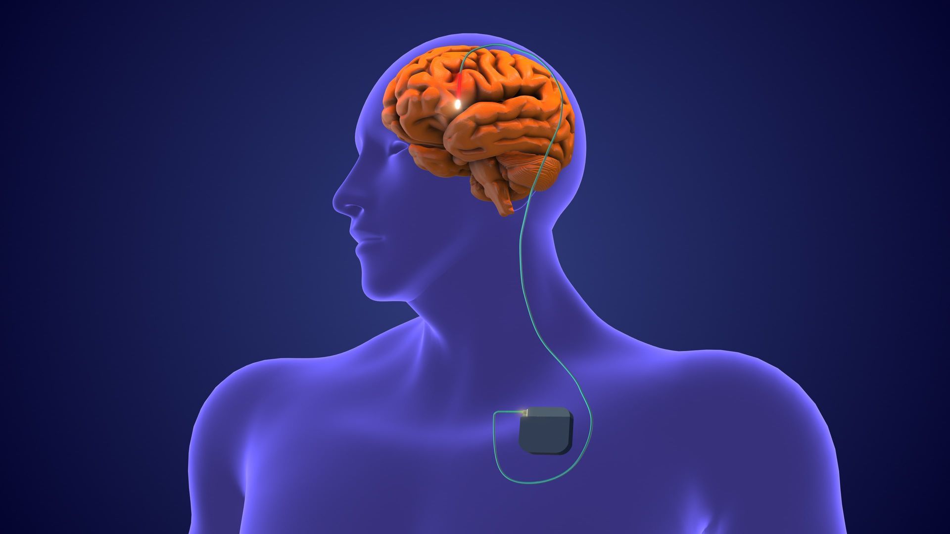 estimulação cerebral profunda