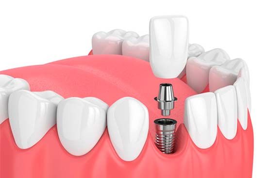 Implante dental y rehabilitación oral