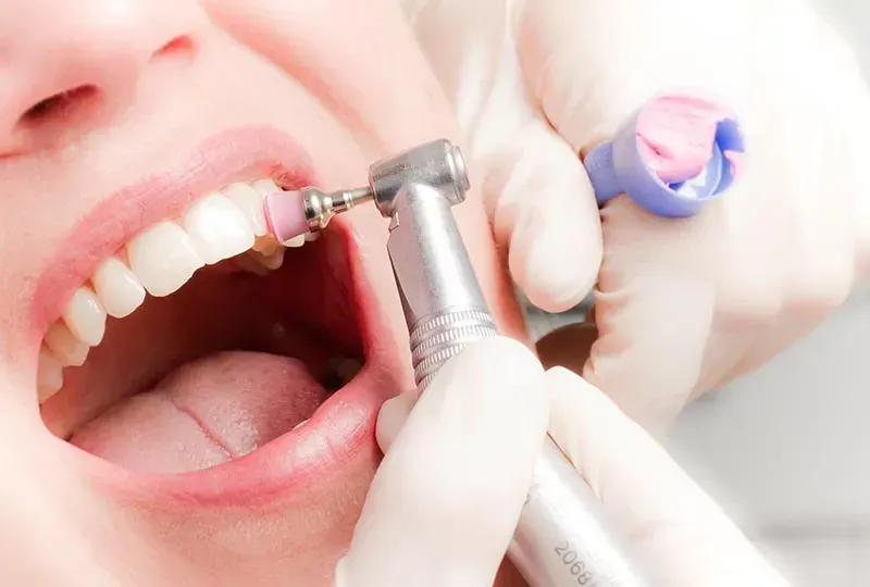 Limpieza dental profesional