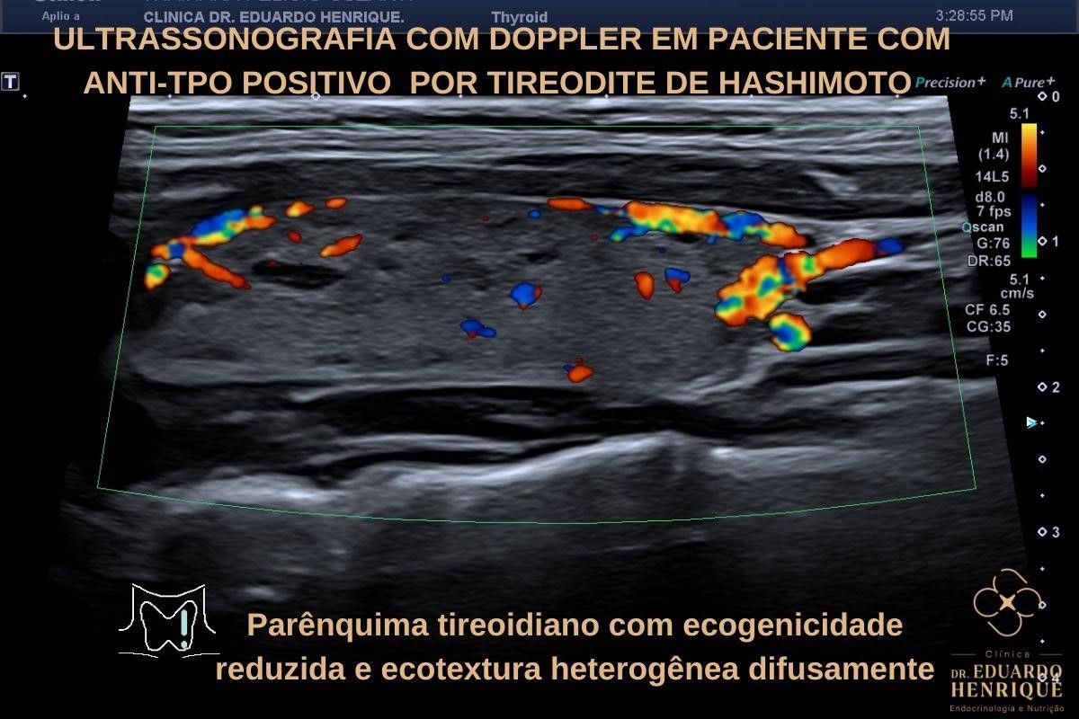 anti-TPO-positivo-dr-eduardo-henrique-endocrinologista-sao-paulo