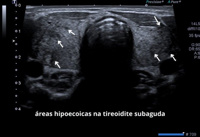 Tireoidite subaguda - entenda mais Tireoidite subaguda - entenda mais