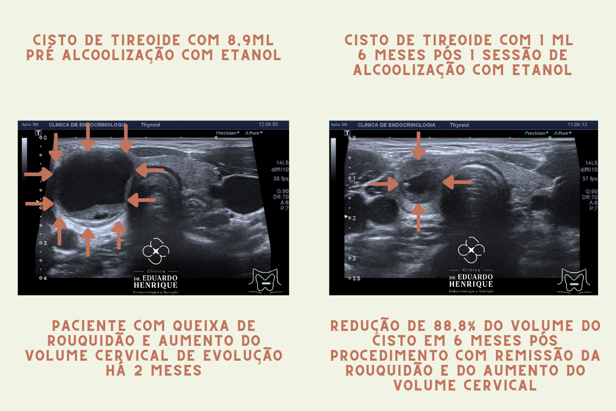 Quais as vantagens da Alcoolização de Cistos e Nódulos de Tiroide? A alcoolização de cistos e nódulos de tireoide oferece diversos benefícios ao paciente, a saber: Quais as vantagens da Alcoolização de Cistos e Nódulos de Tiroide? A alcoolização de cistos e nódulos de tireoide oferece diversos benefícios ao paciente, a saber: