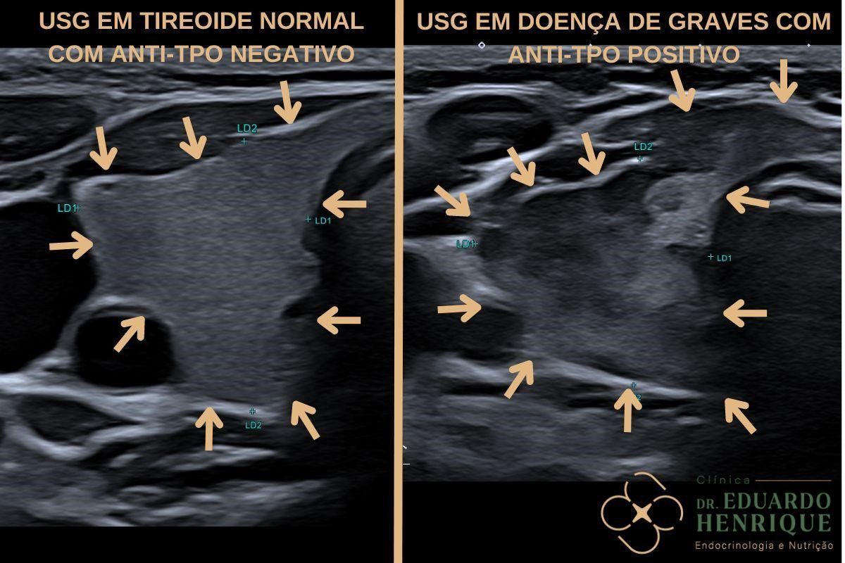 usg-tireoide-doenca-de-graves-dr-eduardo-henrique-endocrinologista-sao-paulo