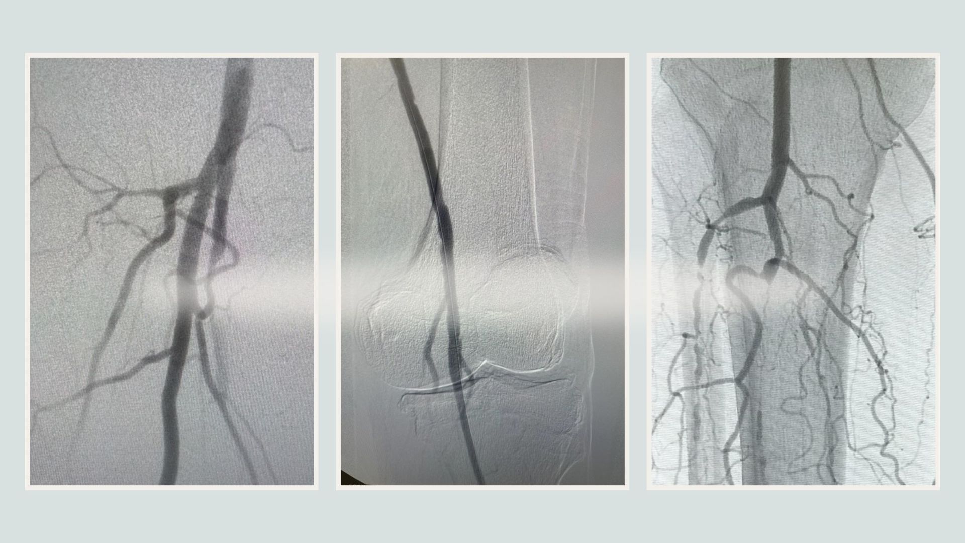 Peripheral Artery Disease