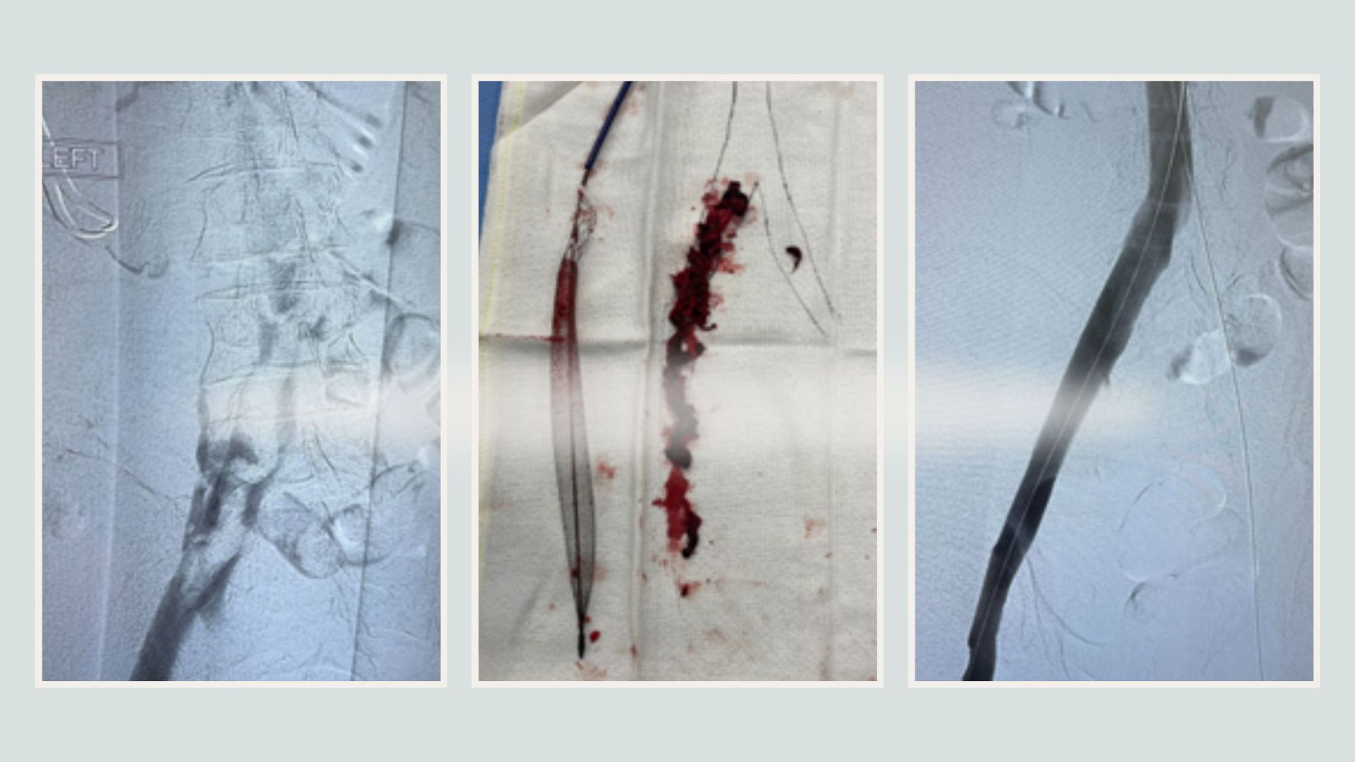 Blood Clots (Deep Vein Thrombosis)