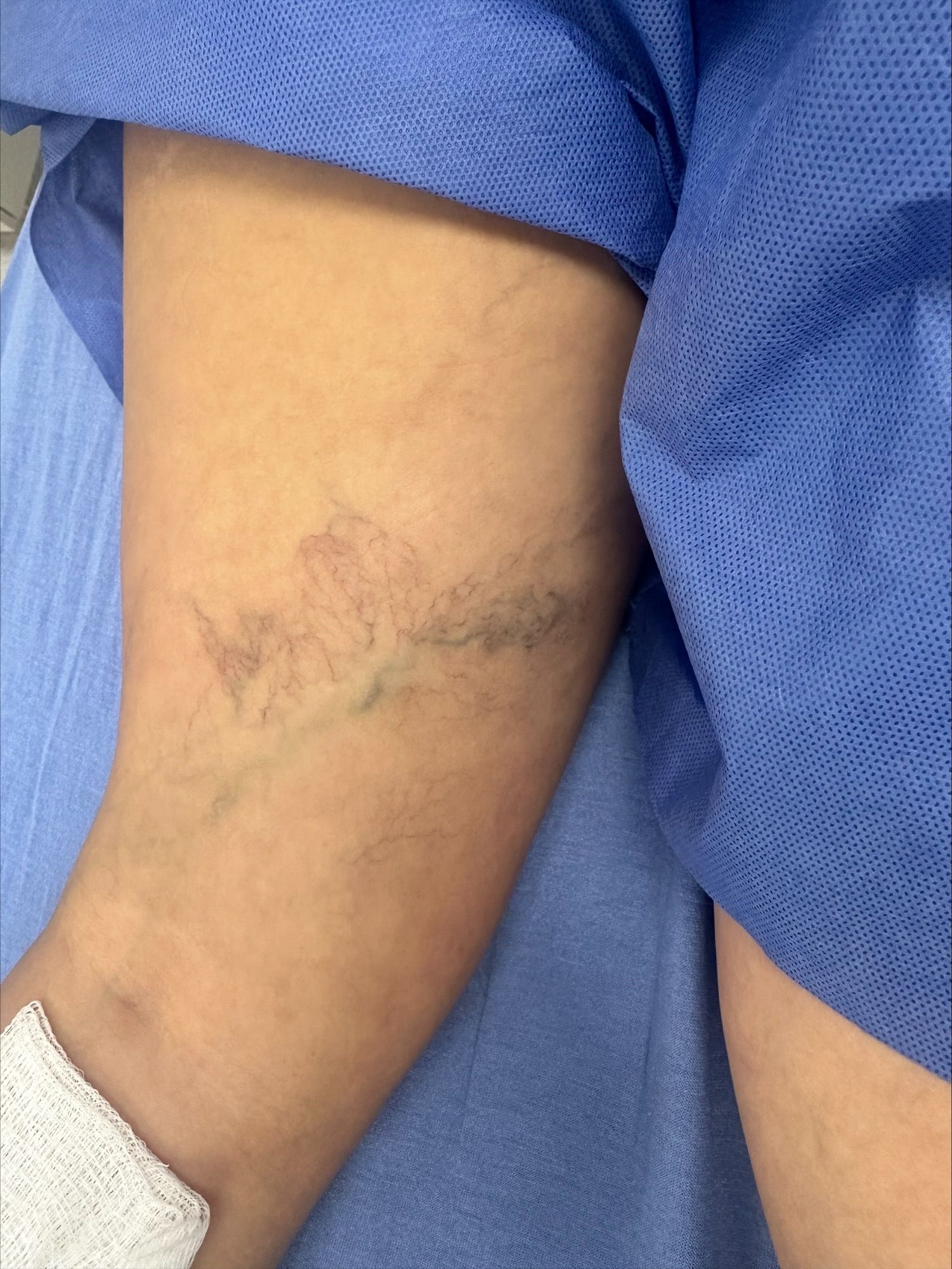 The Importance of Choosing a Vascular Surgeon for Vein Treatment