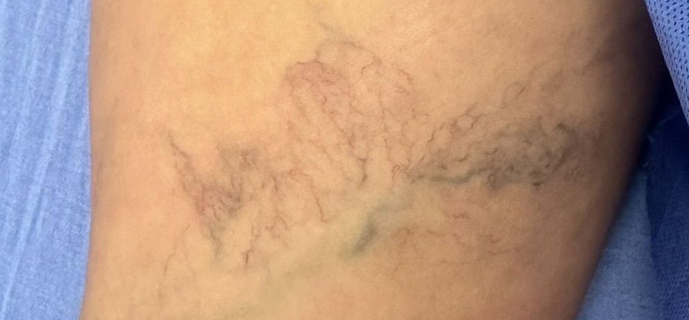 Vein Treatment The Importance of Choosing a Vascular Surgeon for Vein Treatment