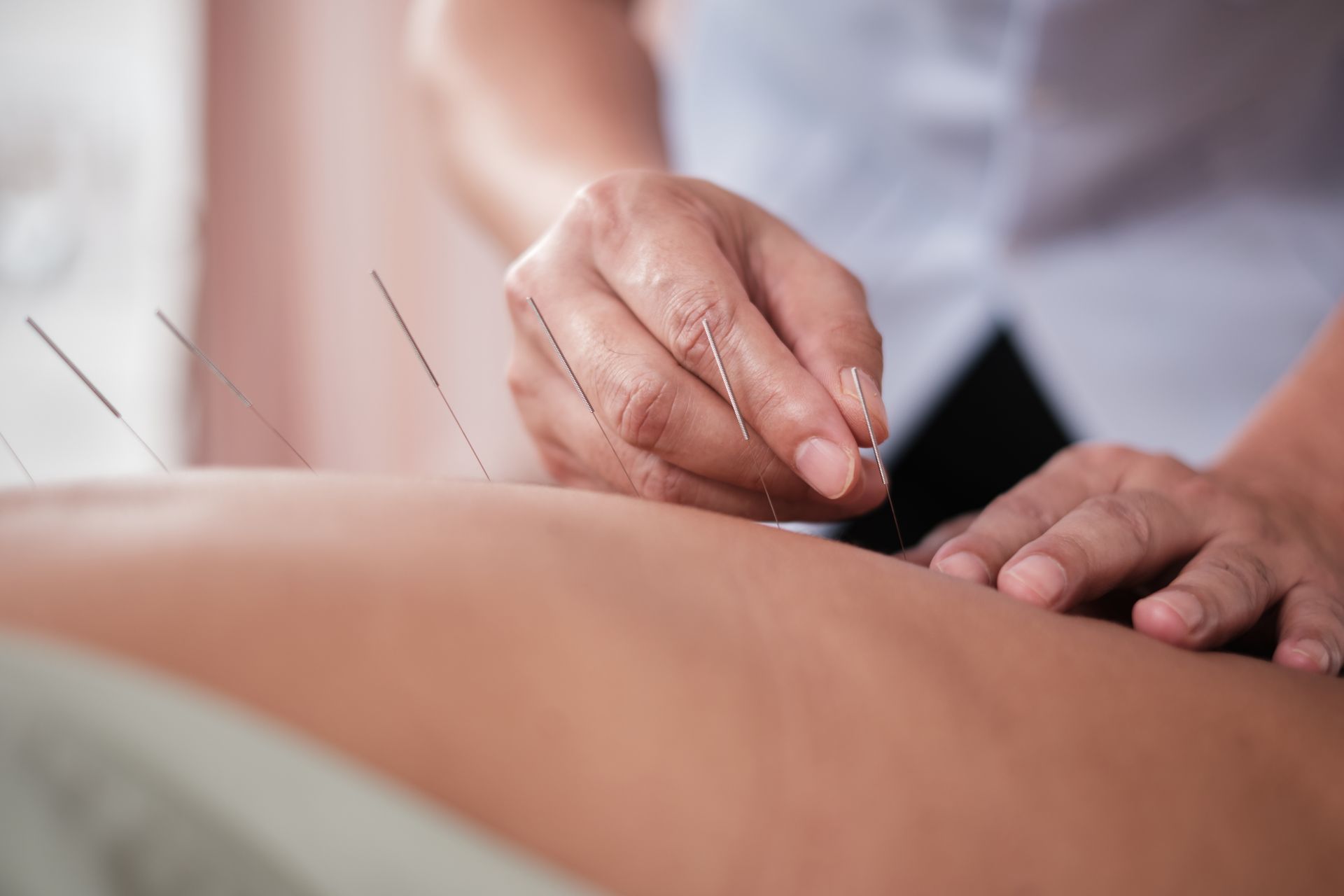 Acupuncture needles being inserted into a person’s back by a practitioner
