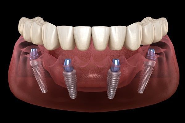 Digital render of an All-on-4 dental implant procedure showing four titanium implants secured into a jawbone.