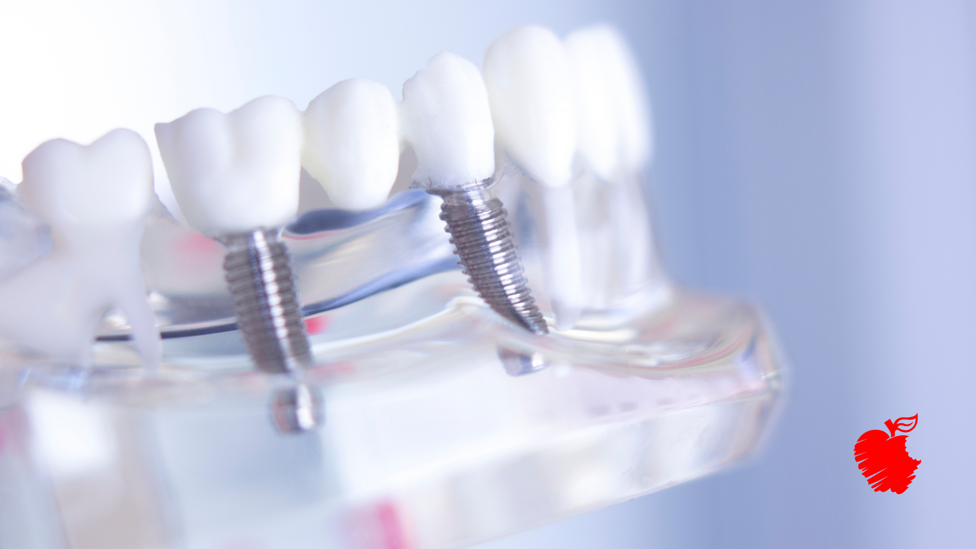 A close up of a model of teeth with dental implants.