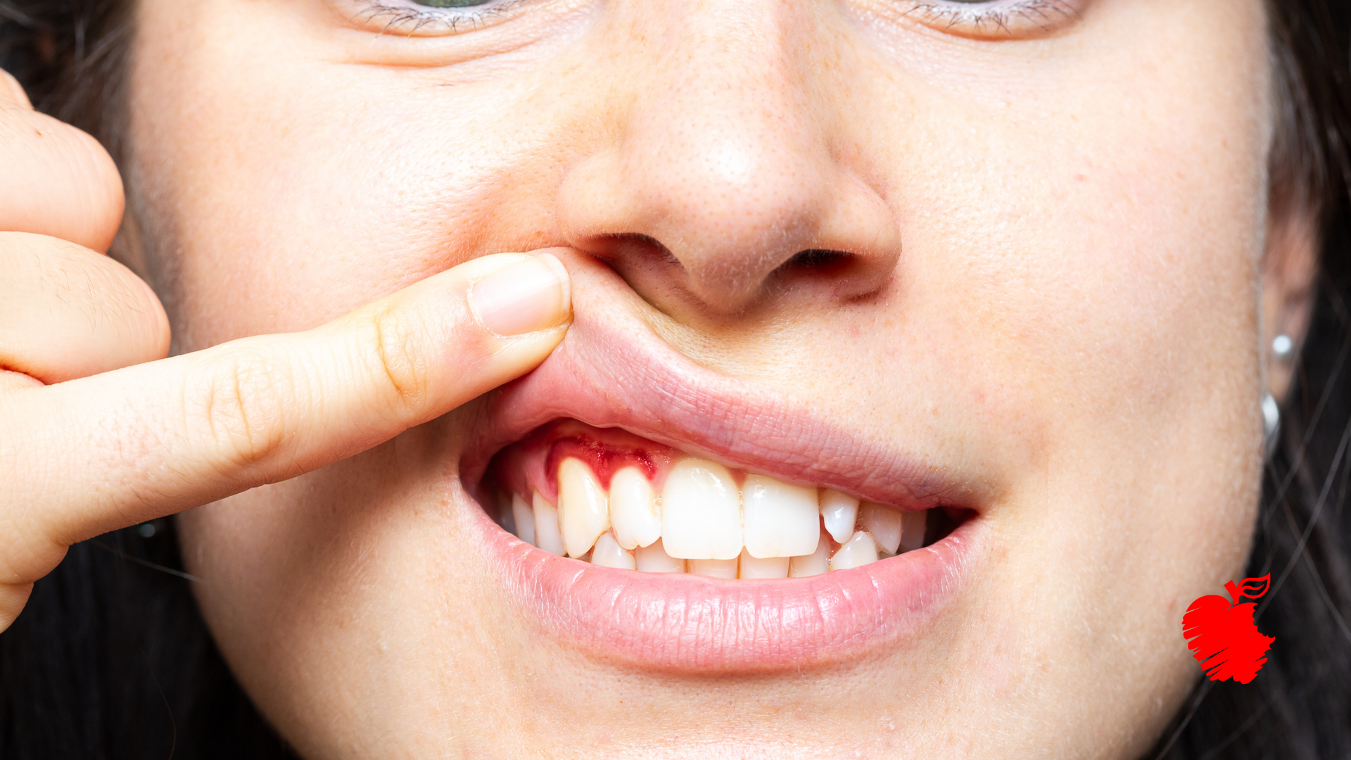 A close up of a woman 's mouth with a red spot on her cheek.