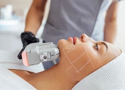 HIFU High Intensity Focused Ultrasound Chin and Neck