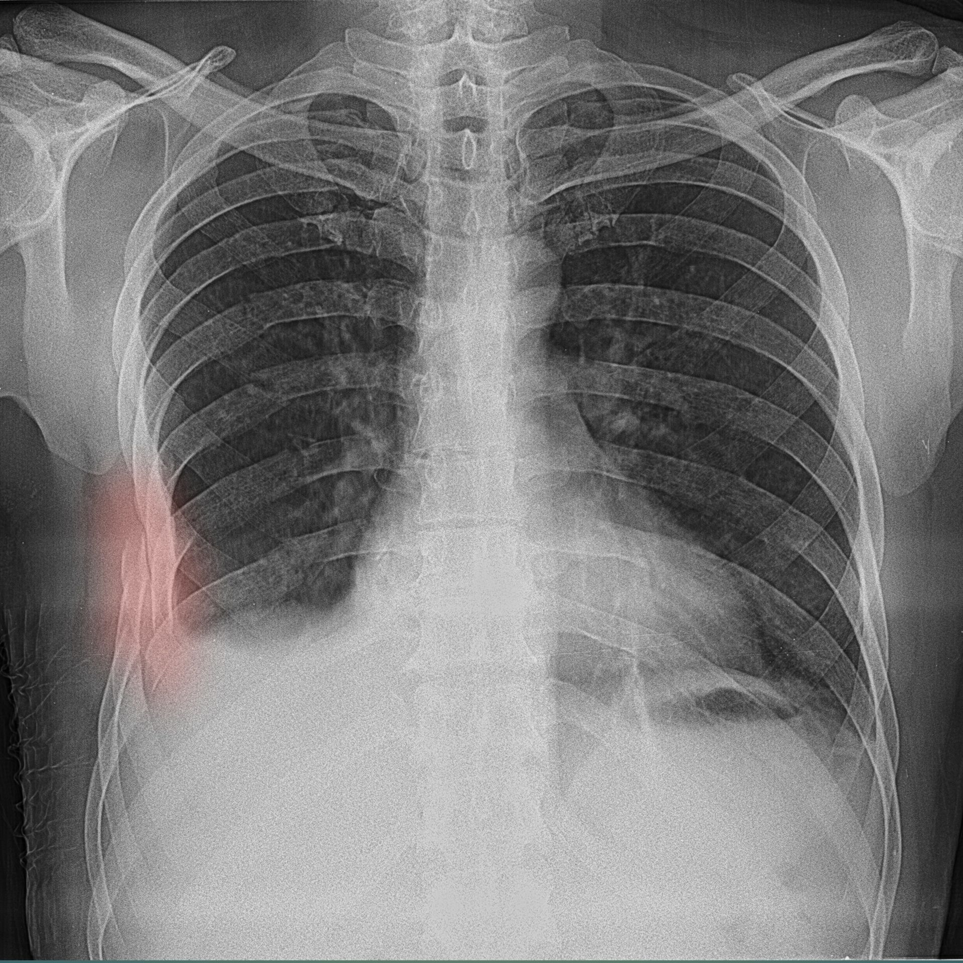 Person with an arm in a cast recovering after a car accident