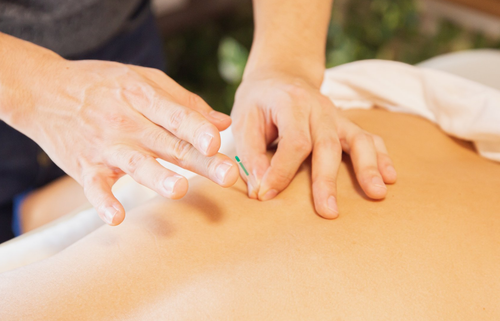 Hands performing acupuncture on a person's back; a needle is inserted.