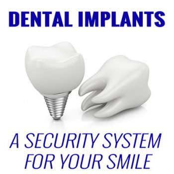 Dental implants are a security system for your smile