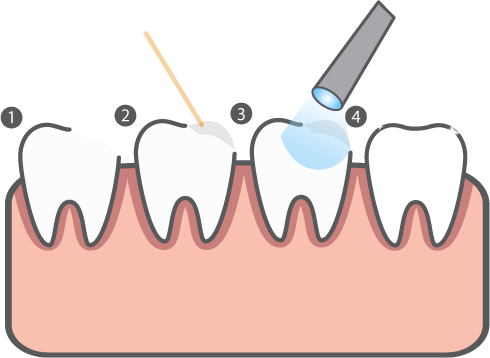 Bonding and Gum Contouring