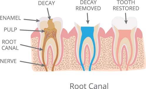 Root Canals