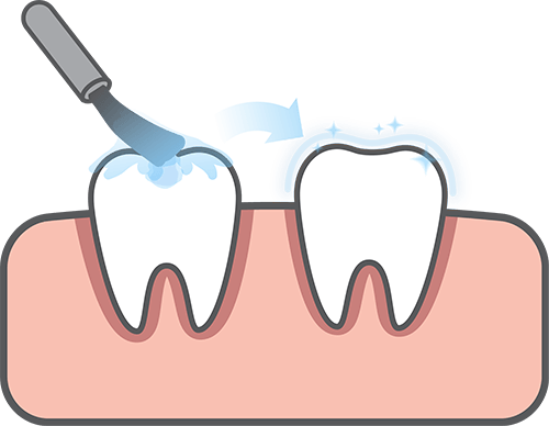 Dental Sealants