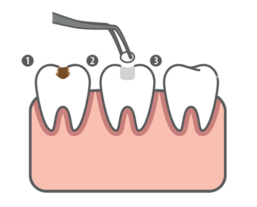 Mercury Filling removal