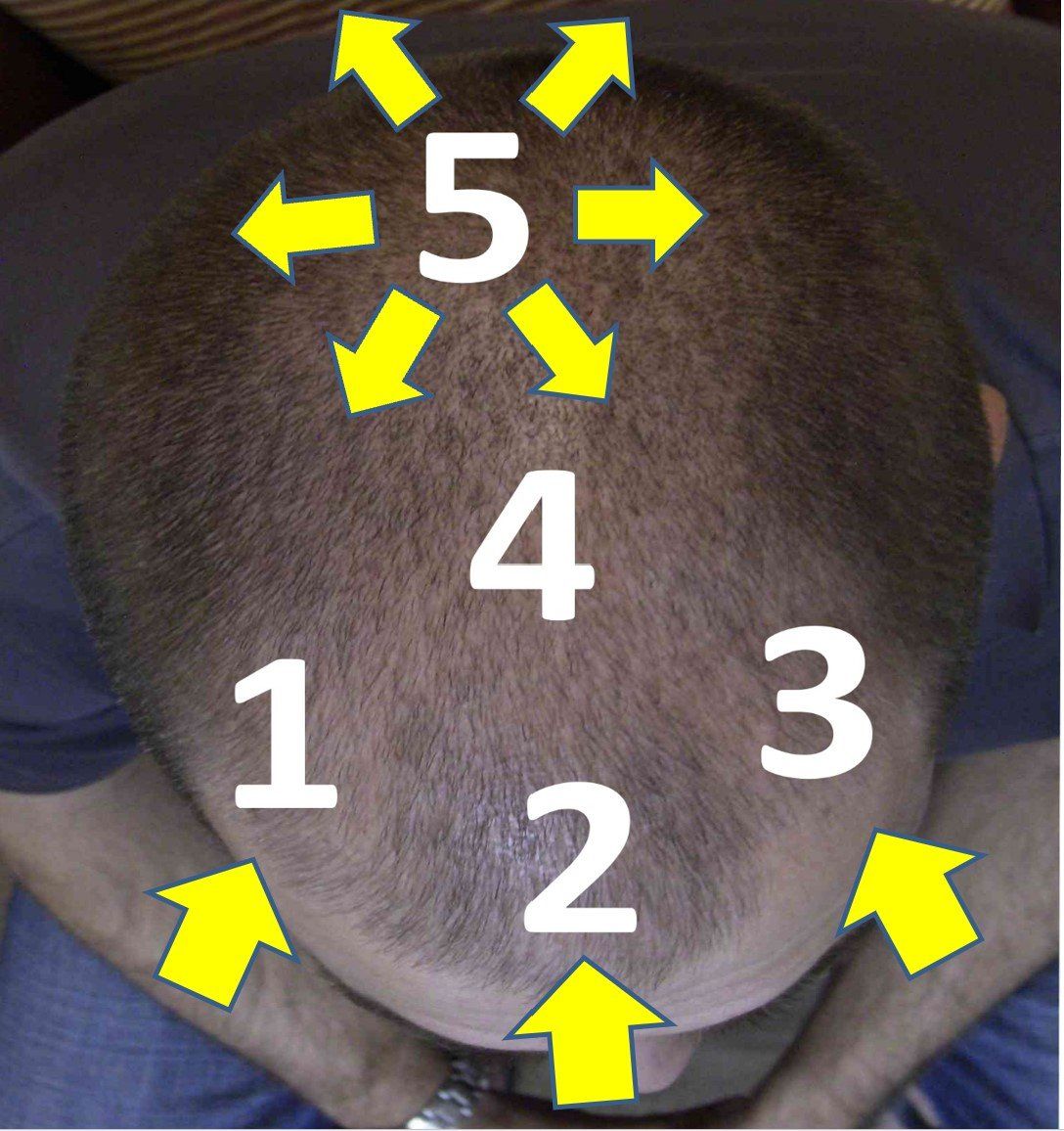 hair regrowth treatment for men